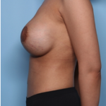 Mommy Makeover Before & After Patient #34324